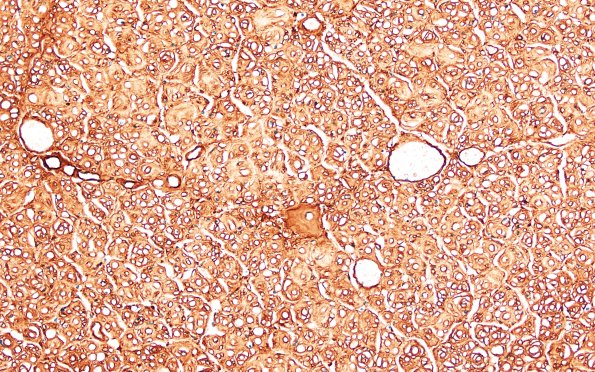 8D3 CIDP (Case 8) Roots Coll IV 20X