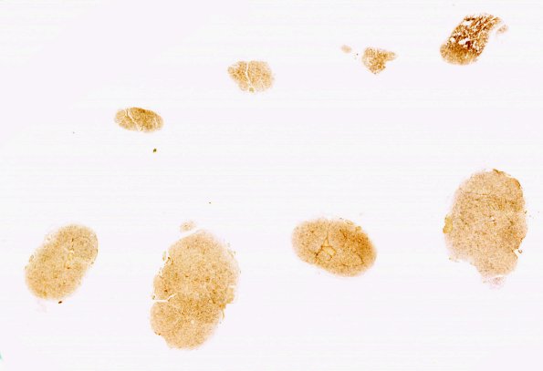 8E1 CIDP (Case 8) Roots N13 NF whole mount