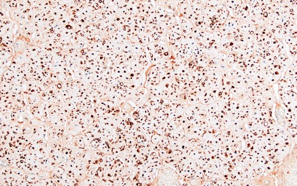 8E3 CIDP (Case 8) Roots NF 1 20X