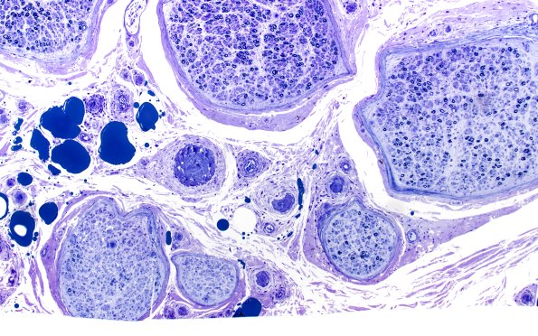 8F1 CIDP (Case 8) Roots Plastic 20X 1