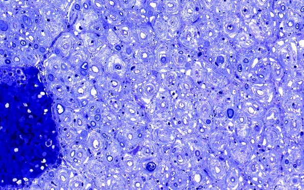 8F2 CIDP (Case 8) Roots Plastic 40X 1