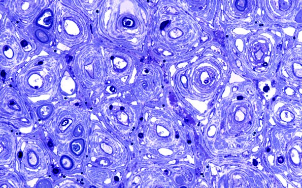 8F3 CIDP (Case 8) Roots Plastic 100X 1