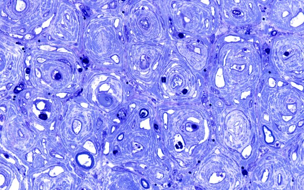 8F4 CIDP (Case 8) Roots Plastic 100X 9