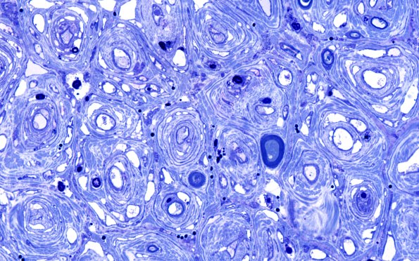 8F5 CIDP (Case 8) Roots Plastic 40X 10