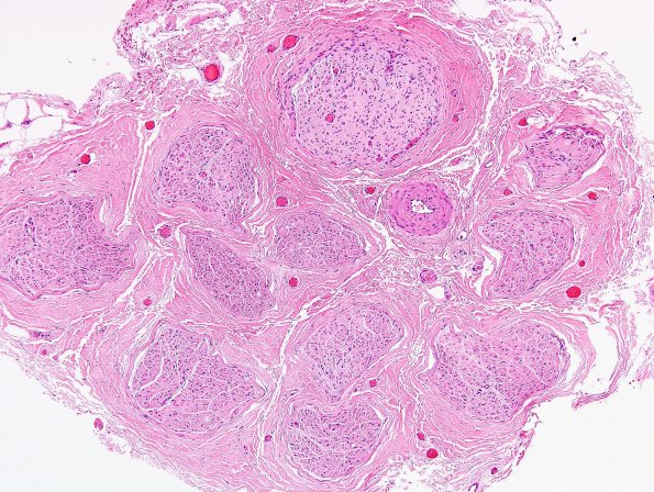 9A1 CIDP, cw (Case 9) H&E 10X.jpg