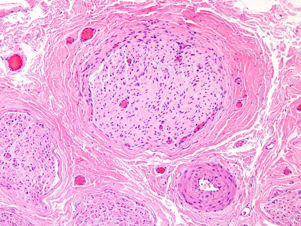 9A2 CIDP, Case 9) H&E 20X.jpg