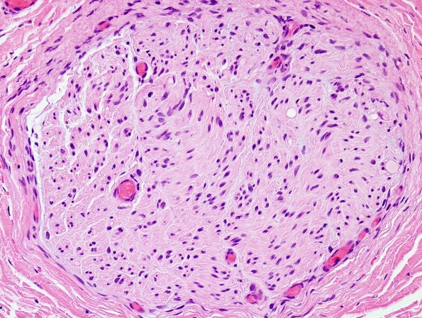 9A3 CIDP, cw (Case 9 H&E 40X.jpg