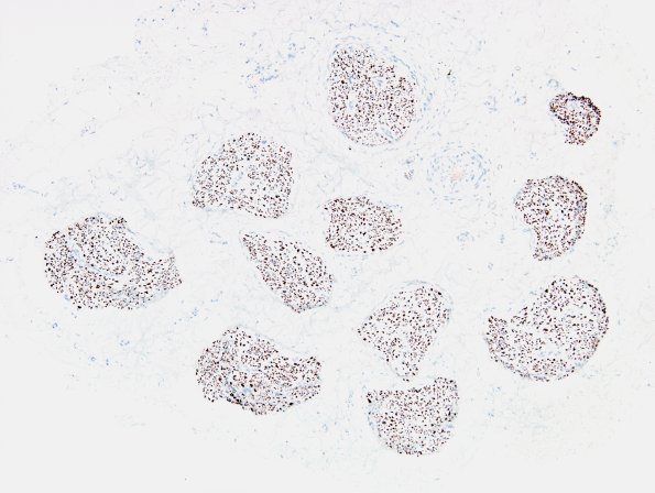 9B1 CIDP, (Case 9) compare with H&E NF 10X.jpg