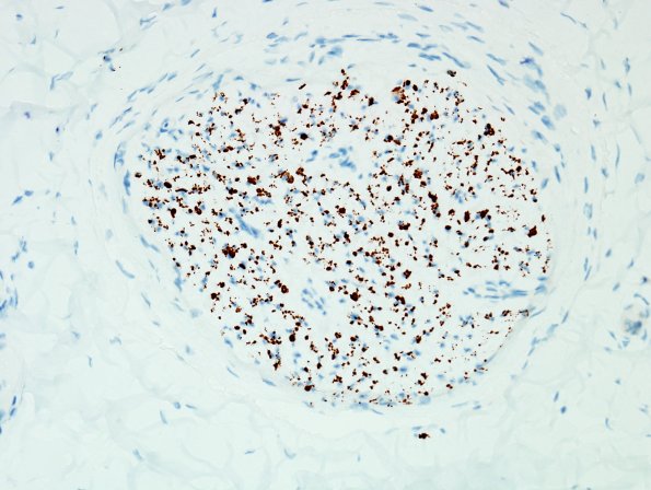 9B2 CIDP, (Case 9) compare with H&E NF 40X.jpg