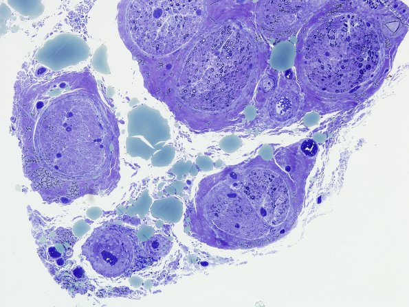 9C1 CIDP, (Case 9) Plastic 7.jpg