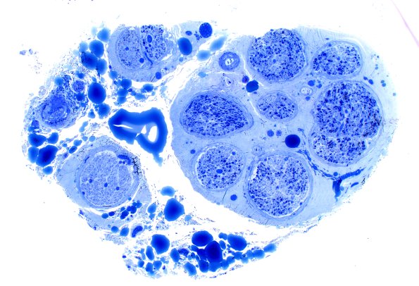 9C3 CIDP,  (Case 9) Plastic 4X 2