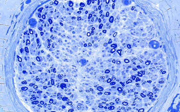 9C4 CIDP,  (Case 9) Plastic 40X