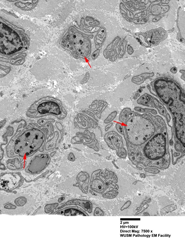 9D2 Case 9 Nerve_016A copy.jpg