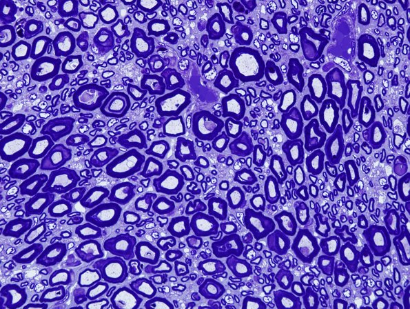 1A5 AMAN (Case 1) Plastic 12.jpg