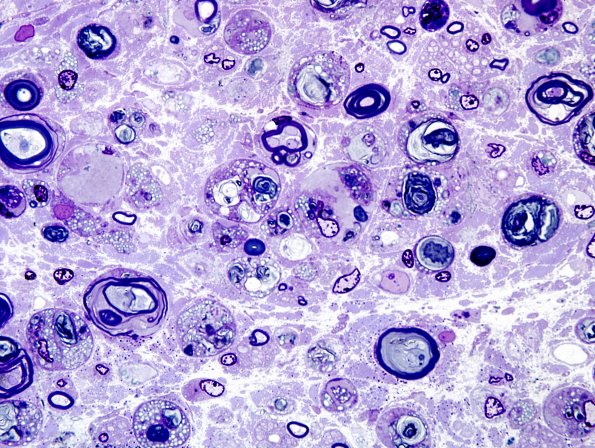 2A1 AMAN (Case 2) Plastic 1.jpg