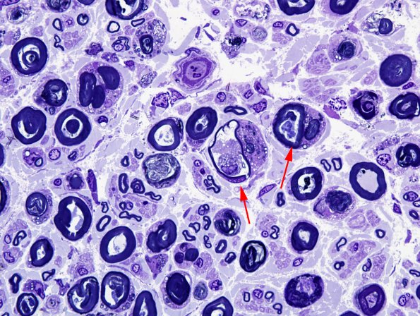 2A3 AMAN (Case 2) Plastic 18 copy.jpg