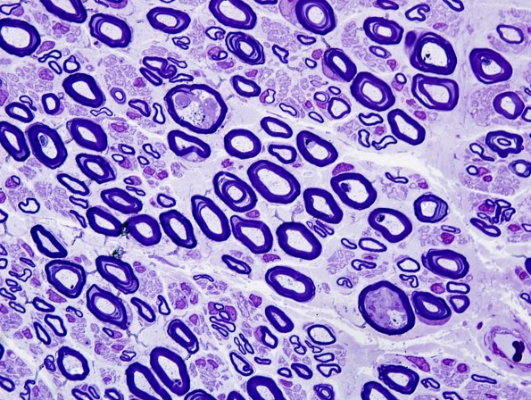 2A4 GBS, axonal type (Case 2) Plastic 1.jpg