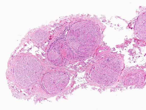 1A1 Sarcoid, no bugs (Case 1) H&E 5