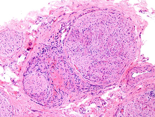1A2 Sarcoid, (Case 1) H&E 4