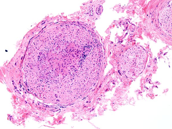 1A4 Sarcoid, no bugs (Case 1) H&E 9