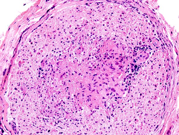 1A5 Sarcoid, no bugs (Case 1) H&E 6