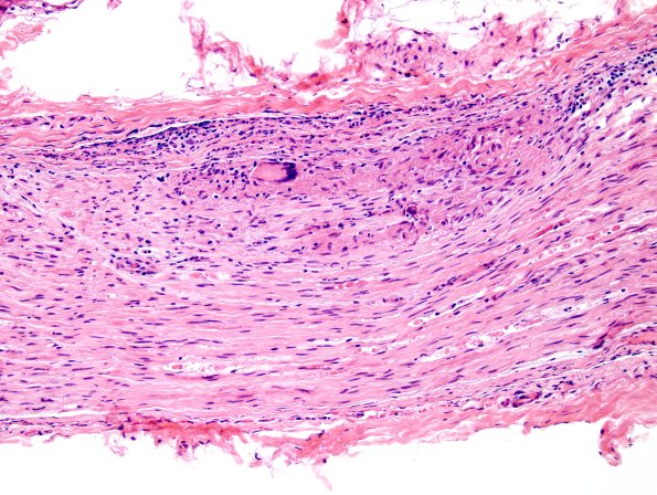 1A6 Sarcoid, no bugs (Case 1) H&E 1