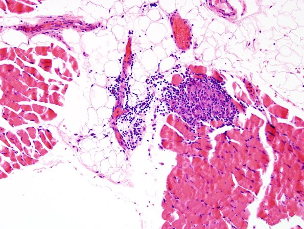 1B1 Sarcoid, no bugs (Case 1) Muscle 3
