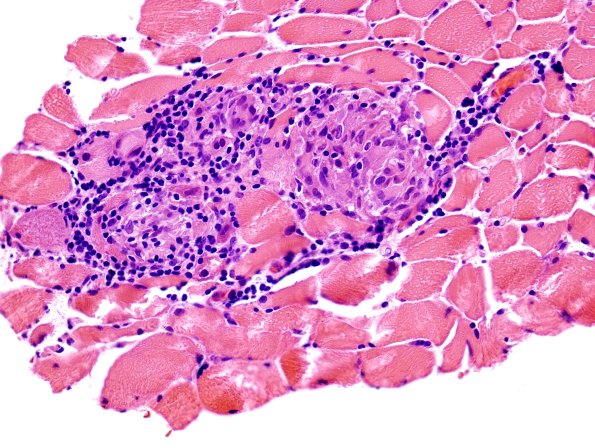 1B2 Sarcoid, no bugs (Case 1) muscle H&E 1
