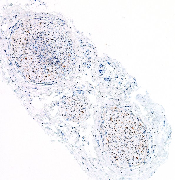 1D1 Sarcoid, no bugs (Case 1) NF 4