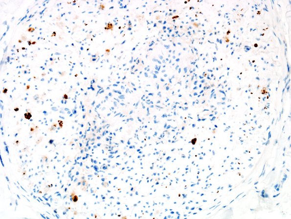 1D3 Sarcoid, no bugs (Case 1) NF 3
