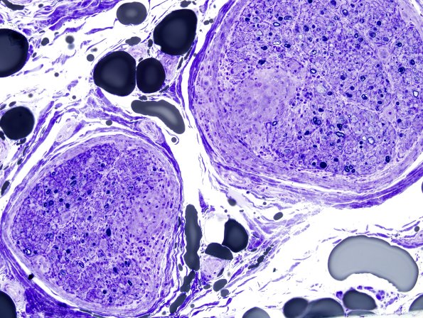 1E1A Sarcoid, no bugs (Case 1) Plastic 10