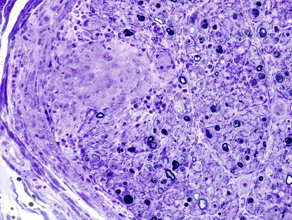 1E1B Sarcoid, no bugs (Case 1) Plastic 3A