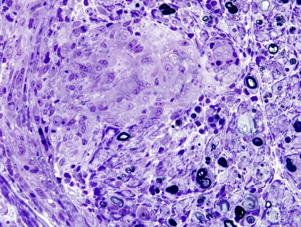 1E1C Sarcoid, no bugs (Case 1) Plastic 4 (2)