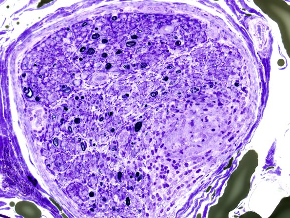 1E1D Sarcoid, no bugs (Case 1) Plastic 6