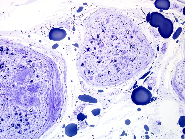 1E2A Sarcoid, no bugs (Case 1) plastic A2.jpg