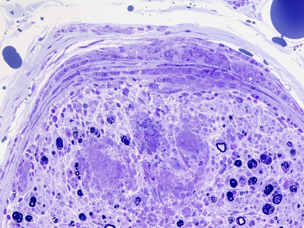 1E2B Sarcoid, no bugs (Case 1) plastic 2.jpg