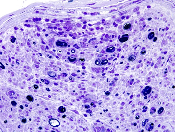 1E4 Sarcoid, no bugs (Case 1) Plastic 21