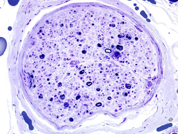 1E7A Sarcoid, no bugs (Case 1) Plastic 20