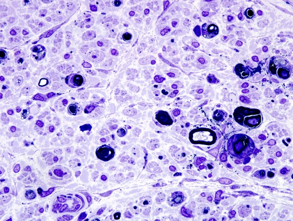 1E7B Sarcoid, no bugs (Case 1) Plastic 18