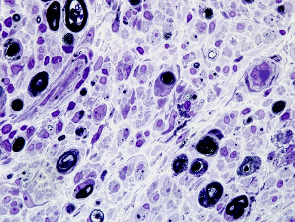 1E8 Sarcoid, no bugs (Case 1) Plastic 3