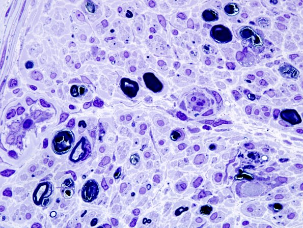 1E9 Sarcoid, no bugs (Case 1) Plastic 16