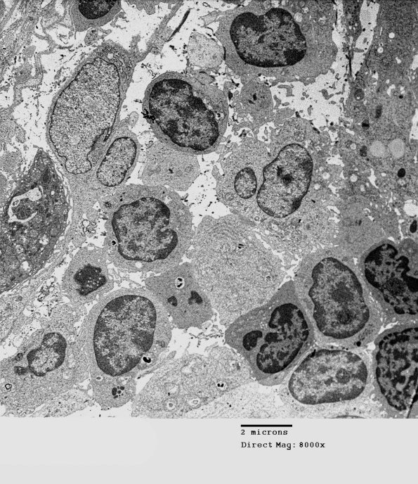 1F5 Sarcoid, no bugs (Case 1) EM 009 - Copy