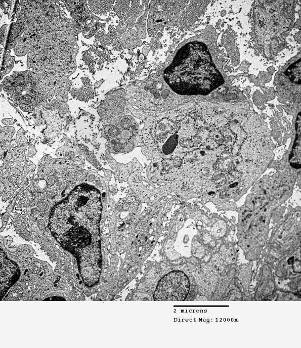 1F6 Sarcoid, no bugs (Case 1) EM 011 - Copy