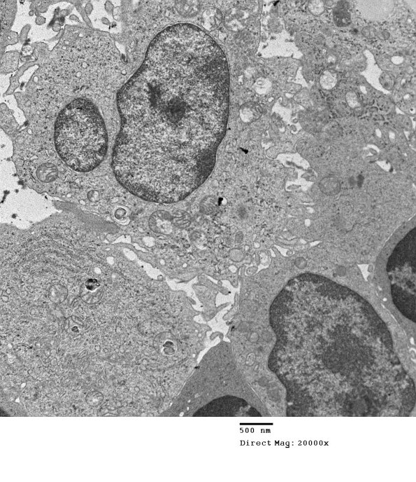 1F7 Sarcoid, no bugs (Case 1) EM 010 - Copy