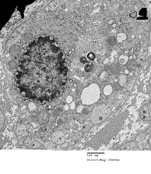 1G1B Sarcoid, no bugs (Case 1) EM 3 - Copy
