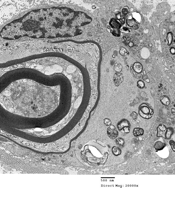 1G3 Sarcoid, no bugs (Case 1) EM 14 - Copy