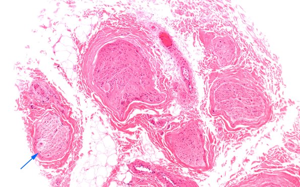 2A1 sarcoid & Chronic Denervation (Case 2) copy