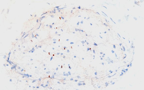 2B Sarcoid & Chronic Denervation (Case 2) NF IHC 60X