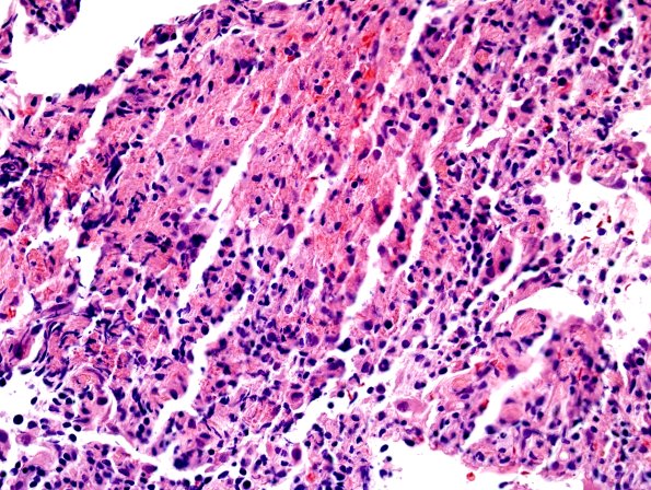 2C1 Sarcoid & Chronic Denervation - lung Bx (Case 2) H&E 1.jpg