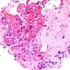 2C2 Sarcoid & Chronic Denervation - lung FNA (Case 2).jpg